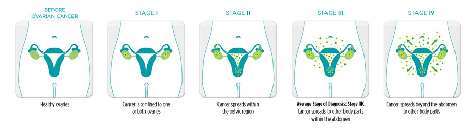 Prognosis Of Uterine Cancer Signs And Symptoms